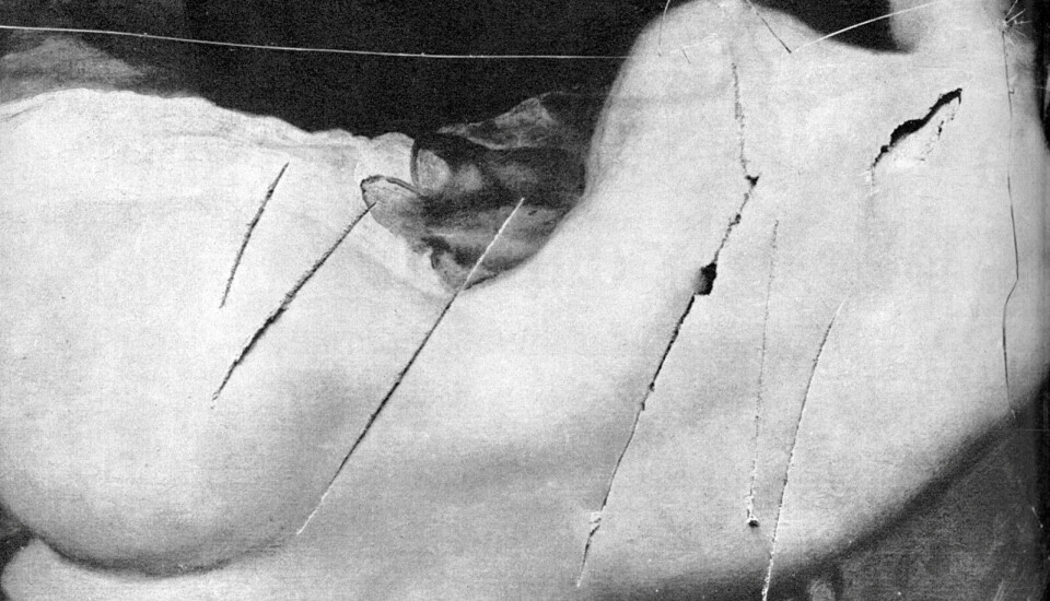 I 1914 ble maleriet The Rokeby Venus av Diego Veláquez (1599–1660) skåret i av Mary Richardson, som var suffragette og medlem av Women’s Social and Political Union. Richardsons intensjon var å skape oppmerksomhet rundt fengslingen av kvinnesaksforkjemperen Emmeline Pankhurst. Foto: Mary Evans Picture / NTB
