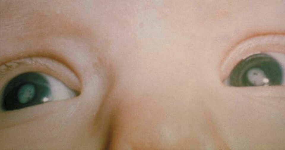 Det mest interessante i lys av vinterens debatt om abort av syke fostre er professor i barnemedisin Ola Didrik Saugstads syn på Downs syndrom, skriver Preben Aavitsland. Foto: Centers for Disease Control and Prevention / United States Department of Health and Human Services